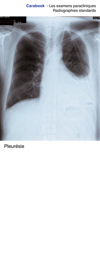 Carabook - Les examens paracliniques
Radiographies standards
Pleurésie
 