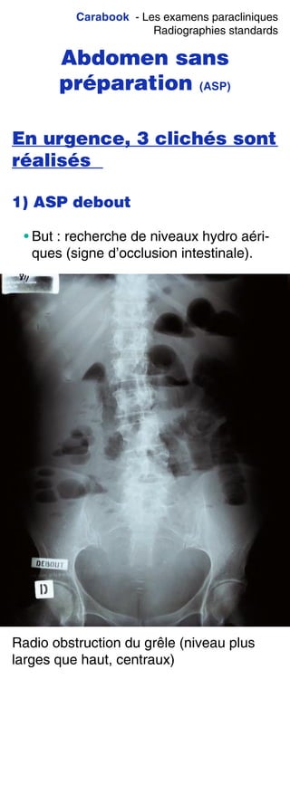 Carabook - Les examens paracliniques
Radiographies standards
Abdomen sans
préparation (ASP)
En urgence, 3 clichés sont
réalisés
1) ASP debout
• But : recherche de niveaux hydro aéri-
ques (signe d’occlusion intestinale).
Radio obstruction du grêle (niveau plus
larges que haut, centraux)
 