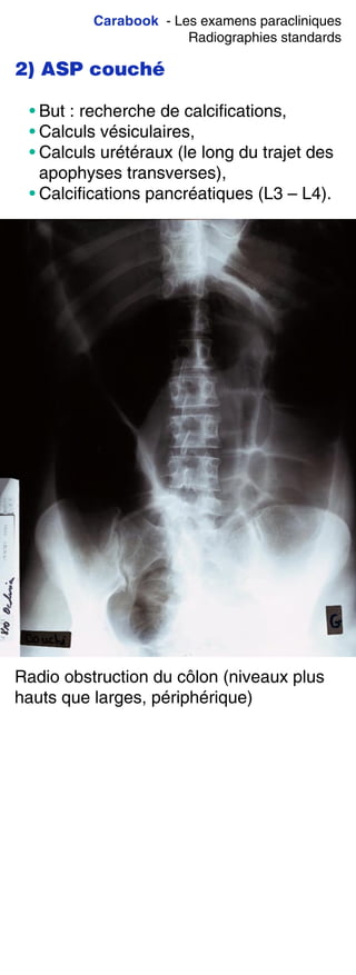 Carabook - Les examens paracliniques
Radiographies standards
2) ASP couché
• But : recherche de calcifications,
• Calculs vésiculaires,
• Calculs urétéraux (le long du trajet des
apophyses transverses),
• Calcifications pancréatiques (L3 – L4).
Radio obstruction du côlon (niveaux plus
hauts que larges, périphérique)
 