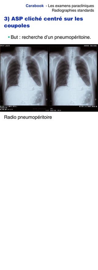 Carabook - Les examens paracliniques
Radiographies standards
3) ASP cliché centré sur les
coupoles
• But : recherche d’un pneumopéritoine.
Radio pneumopéritoire
 