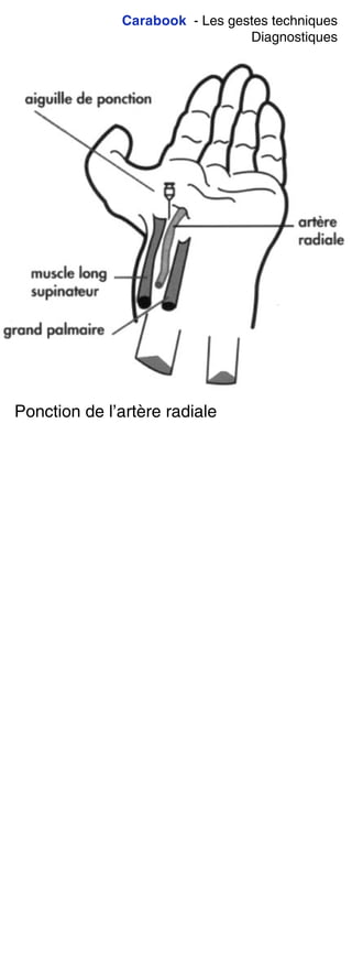 Carabook - Les gestes techniques
Diagnostiques
Ponction de l’artère radiale
 