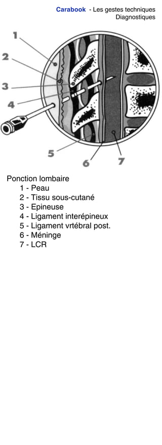 Carabook - Les gestes techniques
Diagnostiques
Ponction lombaire
1 - Peau
2 - Tissu sous-cutané
3 - Epineuse
4 - Ligament interépineux
5 - Ligament vrtébral post.
6 - Méninge
7 - LCR
 