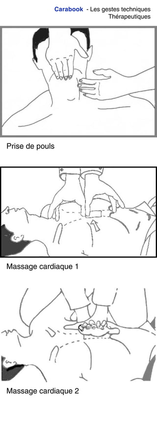 Carabook - Les gestes techniques
Thérapeutiques
Prise de pouls
Massage cardiaque 1
Massage cardiaque 2
 
