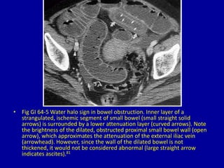 64 attenuation patterns in the abnormal bowel wall | PPTX