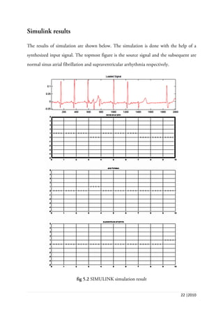 22 |2010
Simulink results
The results of simulation are shown below. The simulation is done with the help of a
synthesized input signal. The topmost figure is the source signal and the subsequent are
normal sinus atrial fibrillation and supraventricular arrhythmia respectively.
fig 5.2 SIMULINK simulation result
 