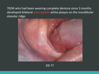 White lesions of oral cavity | PPTX
