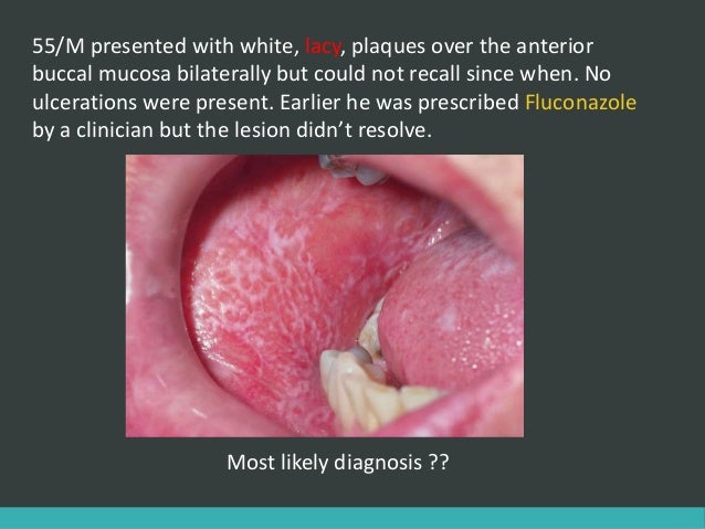 White lesions of oral cavity