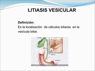 Definición:
Es la localización de cálculos biliares en la
vesícula biliar.
LITIASIS VESICULAR
 