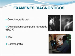 EXAMENES DIAGNOSTICOS
Colecistografía oral
Colangiopancreatografîa retrógrada
(ERCP)
TAC
Gammagrafia
 