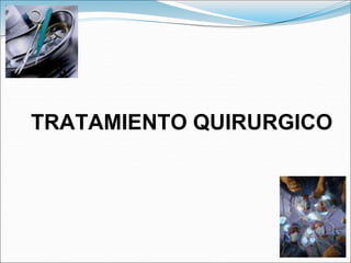 TRATAMIENTO QUIRURGICO
 