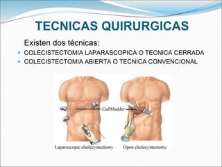 TECNICAS QUIRURGICAS
Existen dos técnicas:
 COLECISTECTOMIA LAPARASCOPICA O TECNICA CERRADA
 COLECISTECTOMIA ABIERTA O TECNICA CONVENCIONAL
 