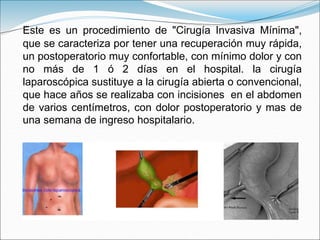 Este es un procedimiento de "Cirugía Invasiva Mínima",
que se caracteriza por tener una recuperación muy rápida,
un postoperatorio muy confortable, con mínimo dolor y con
no más de 1 ó 2 días en el hospital. la cirugía
laparoscópica sustituye a la cirugía abierta o convencional,
que hace años se realizaba con incisiones en el abdomen
de varios centímetros, con dolor postoperatorio y mas de
una semana de ingreso hospitalario.
 