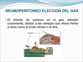 NEUMOPERITONEO ELECCION DEL GAS
 El dióxido de carbono es el gas utilizado
unanimente, debido a las ventajas que ofrece frente
a otros como el óxido nitroso o el aire.
 