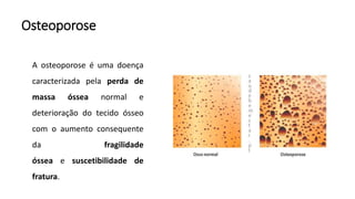 Osteoporose
A osteoporose é uma doença
caracterizada pela perda de
massa óssea normal e
deterioração do tecido ósseo
com o aumento consequente
da fragilidade
óssea e suscetibilidade de
fratura.
 