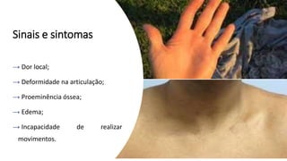 Sinais e sintomas
→ Dor local;
→ Deformidade na articulação;
→ Proeminência óssea;
→ Edema;
→ Incapacidade de realizar
movimentos.
 