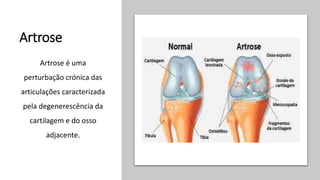 Artrose
Artrose é uma
perturbação crónica das
articulações caracterizada
pela degenerescência da
cartilagem e do osso
adjacente.
 