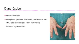Diagnóstico
→Exames de sangue
→Radiografias (mostram alterações características nas
articulações causadas pela artrite reumatoide)
→Exame do líquido articular
 