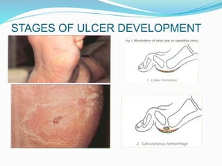 STAGES OF ULCER DEVELOPMENT
 