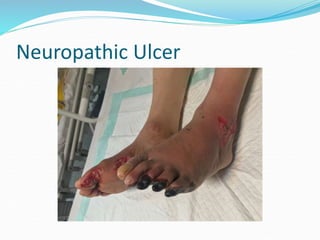 Neuropathic Ulcer
 