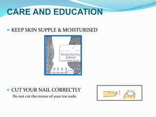 CARE AND EDUCATION
 KEEP SKIN SUPPLE & MOISTURISED
 CUT YOUR NAIL CORRECTLY
Do not cut the corner of your toe nails
 
