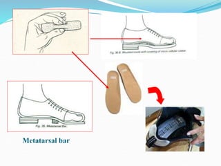 Metatarsal bar
 