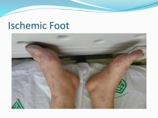 Ischemic Foot
 