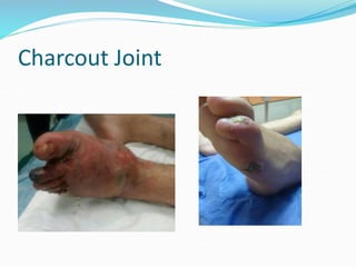 Charcout Joint
 
