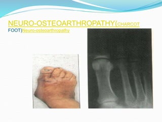 NEURO-OSTEOARTHROPATHY(CHARCOT
FOOT)Neuro-osteoarthropathy
 
