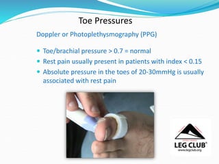 Toe Pressures
Doppler or Photoplethysmography (PPG)
 Toe/brachial pressure > 0.7 = normal
 Rest pain usually present in patients with index < 0.15
 Absolute pressure in the toes of 20-30mmHg is usually
associated with rest pain
 
