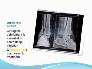 Diabetic Foot
Infection
Surgical
debridment is
essential in
acute deep
infection
Osteomylitis(
diagnoses &
treatment
 
