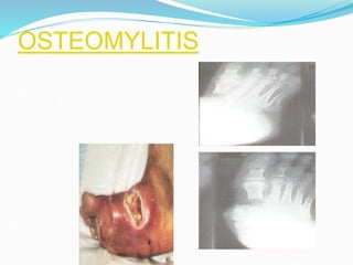 OSTEOMYLITIS
 
