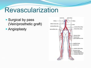 Revascularization
 Surgical by pass
(Vein/prosthetic graft)
 Angioplasty
 