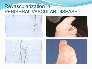 PERIPHRAL VASCULAR DISEASE
Revascularization in
 