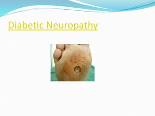 Diabetic Neuropathy
 