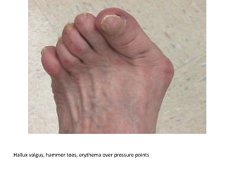Hallux valgus, hammer toes, erythema over pressure points
 