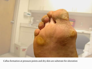 Callus formation at pressure points and dry skin are substrate for ulceration
 