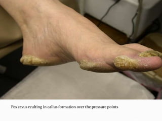 Pes cavus reulting in callus formation over the pressure points
 