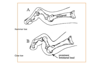 Hammer toe
Claw toe
 