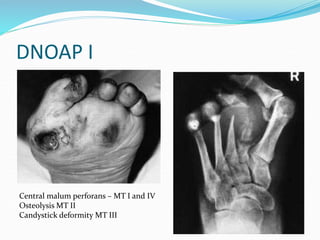 DNOAP I
Central malum perforans – MT I and IV
Osteolysis MT II
Candystick deformity MT III
 