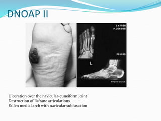DNOAP II
Ulceration over the navicular-cuneiform joint
Destruction of lisfranc articulations
Fallen medial arch with navicular subluxation
 