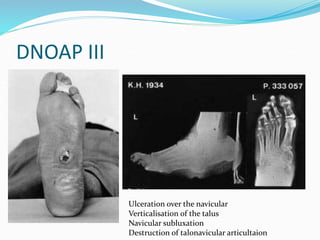 DNOAP III
Ulceration over the navicular
Verticalisation of the talus
Navicular subluxation
Destruction of talonavicular articultaion
 