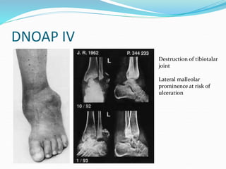 DNOAP IV
Destruction of tibiotalar
joint
Lateral malleolar
prominence at risk of
ulceration
 