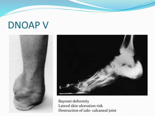 DNOAP V
Bayonet deformity
Lateral skin ulceration risk
Destruction of talo- calcaneal joint
 