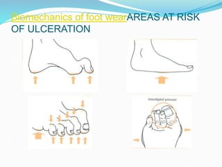 Biomechanics of foot wearAREAS AT RISK
OF ULCERATION
 