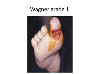 Wagner grade 1
 