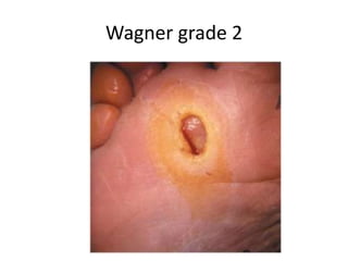 Wagner grade 2
 