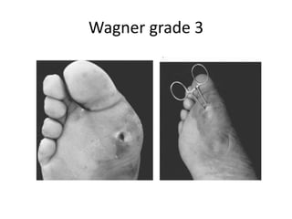 Wagner grade 3
 