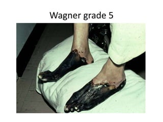Wagner grade 5
 