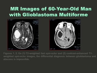 66-Dr Ahmed Esawy  imaging oral board of  function MRI MRS DWI MRI PERFUSION