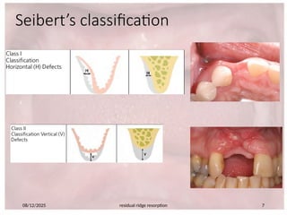 Siberet Ridge Defect 660365804-Residual-ridge-resorption-seminar-PART-2.pptx